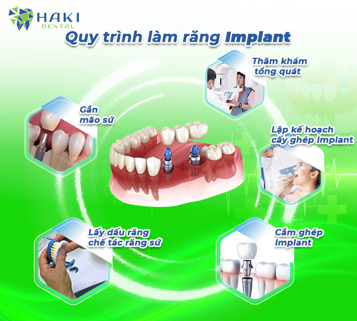 Quy trinh trong rang implant tai Haki Dental