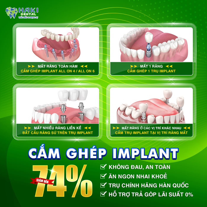 uu-dai-haki-dental-thang-9-cam-ghep-implant